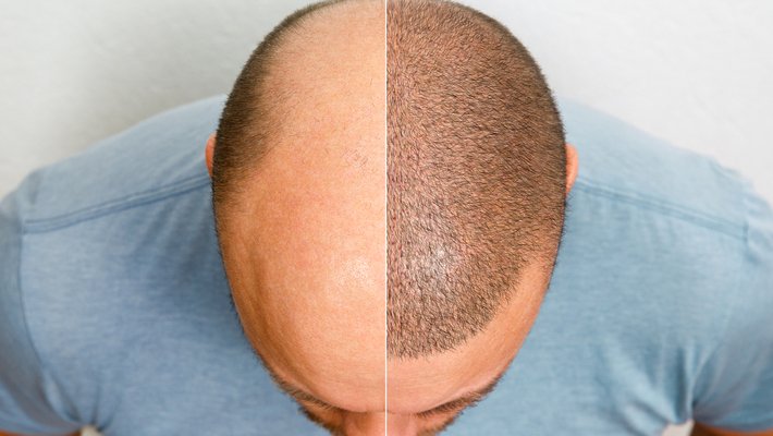 Transplante capilar masculino